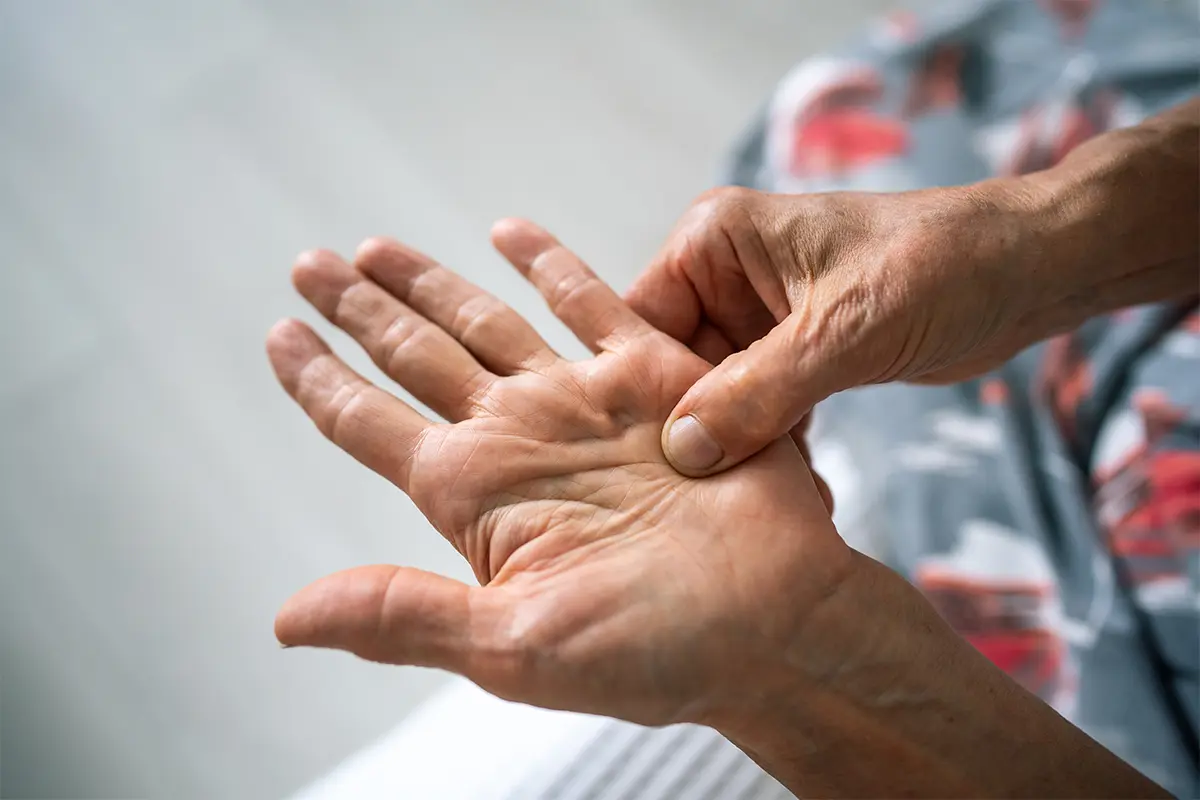 Morbo di Dupuytren Immagine mano