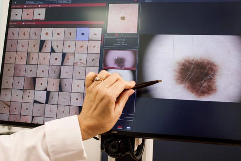 Polo Salute Lucca | Mappatura dei nei con FotoFinder: come funziona, chi dovrebbe farla e perché è uno degli strumenti più efficaci per la prevenzione del melanoma