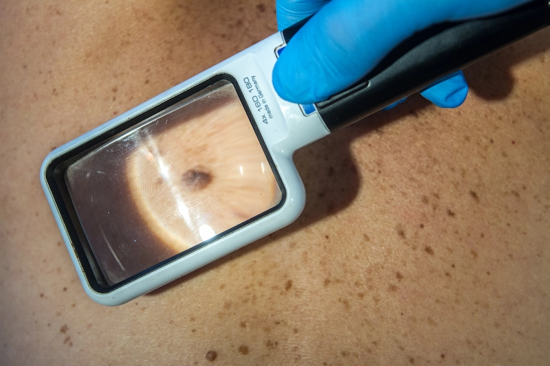 Polo Salute Lucca | Ogni quanto fare la mappatura dei nei? Guida completa alla prevenzione del melanoma