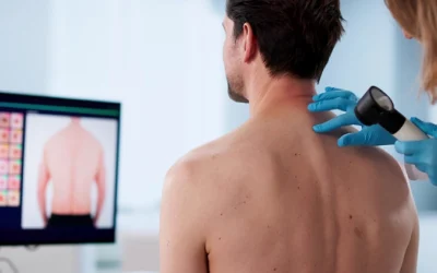 Prevenzione del melanoma: quando controllare i nei e perché la diagnosi precoce può fare la differenza Polo Salute Lucca | Prevenzione del melanoma: quando controllare i nei e perché la diagnosi precoce può fare la differenza