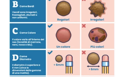 Polo Salute Lucca | Regola ABCDE del melanoma: come controllare i nei e riconoscere i segnali di rischio