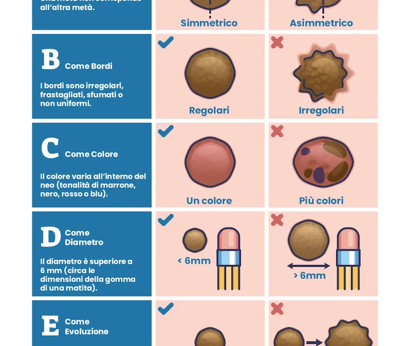 Polo Salute Lucca | Regola ABCDE del melanoma: come controllare i nei e riconoscere i segnali di rischio